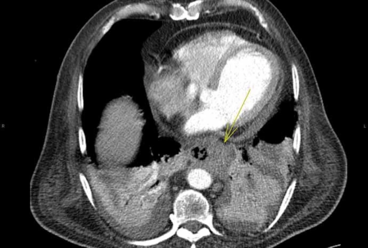 Tumorózní infiltrace distálního jícnu.<br> Fig. 4. Tumorous infiltration of distal oesophageus.