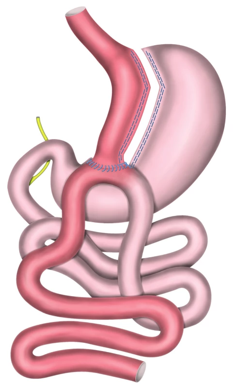 MGB/OAGB – Minigastrický bypass žaludku s jednou
anastomózou<br>
Fig. 2: MGB/OAGB − Mini Gastric Bypass/One Anastomosis
Gastric Bypass