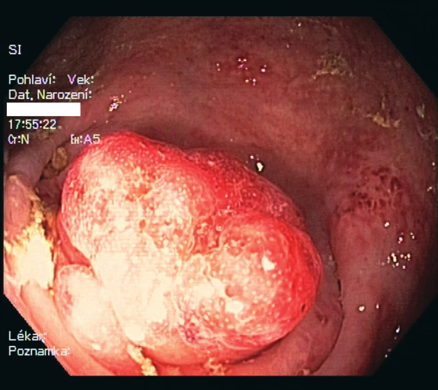 Endoskopický nález přisedlé polypoidní léze
protrudující z ústí apendixu do lumen céka, velikost
cca 15x15 mm<br>
Fig. 2: Endoscopic finding of settled polypoid lesion protruding
from the appendiceal orifice to the caecal lumen,
15x15mm