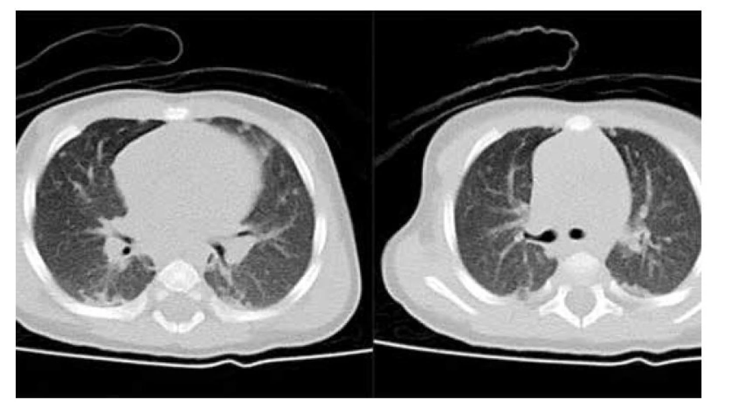 Postižení plic při LCH: a, b) nativní CT scany v axiální rovině, vícečetné drobné noduly
plicní tkáně oboustranně.<br>
Fig. 5. LCH lung disorder: a, b) CT scans in axial plane, some lung nodules on both sides.