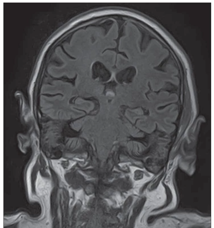 MR mozku, FLAIR, koronární snímek – normální nález.<br>
FLAIR – fluid attenuated inversion recovery<br>
Fig. 1. Brain MRI, FLAIR, coronary view – normal findings.<br>
FLAIR – fluid attenuated inversion recovery