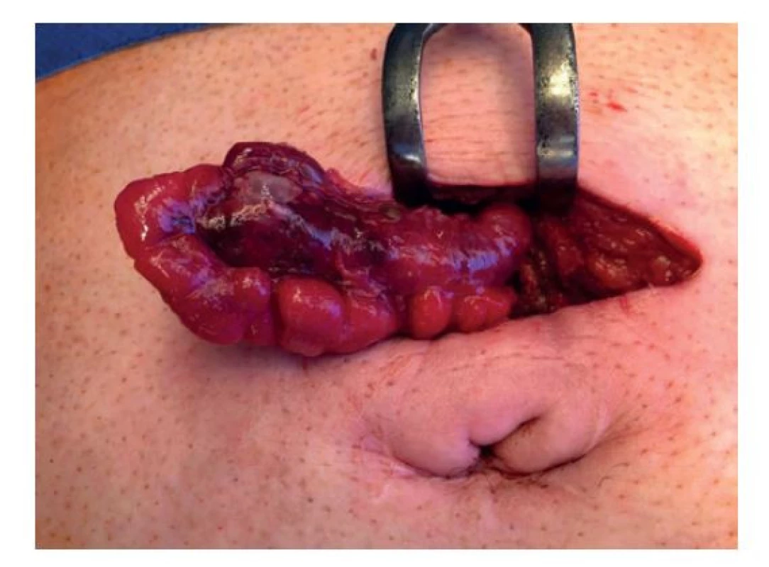 Peroperační nález<br>
Fig. 2: Peroperative finding