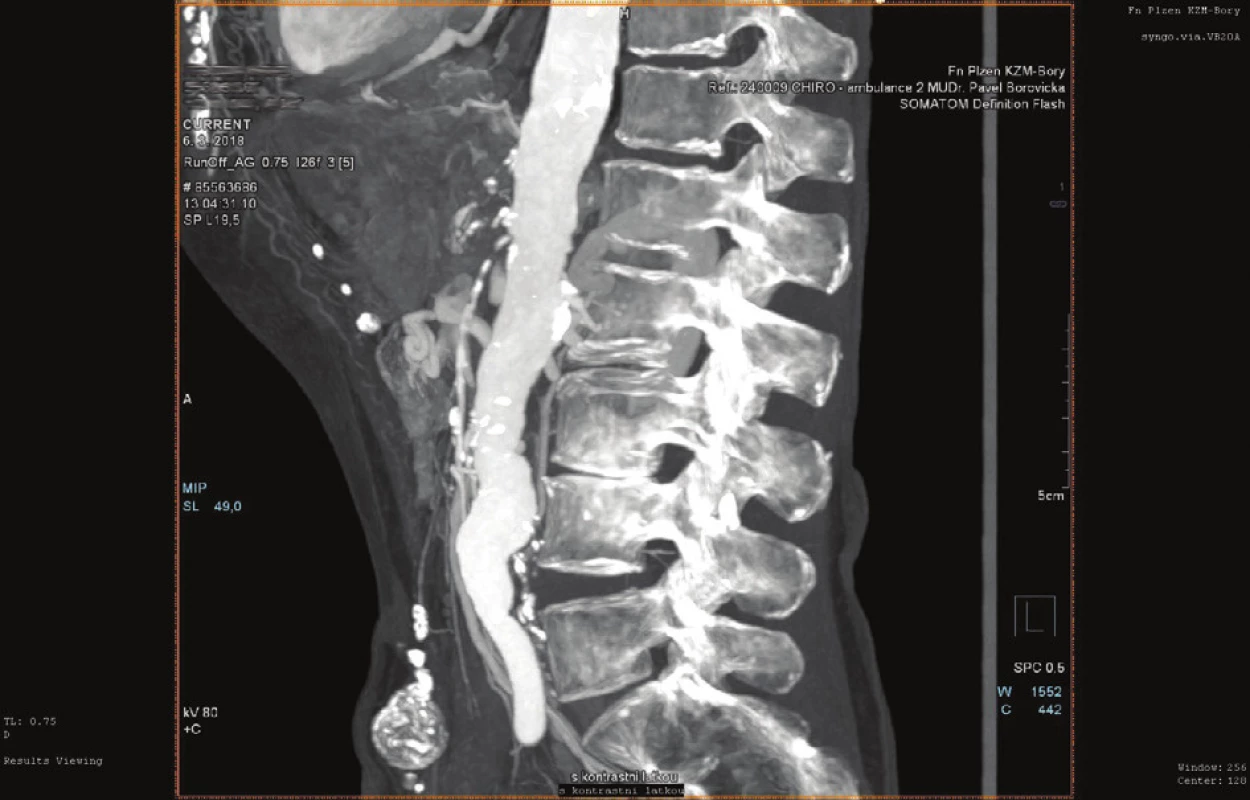 Uzávěr viscerálních tepen – nález nevhodný k endovaskulární
intervenci (CT AG)<br>
Fig. 4: Visceral artery occlusion – a finding unsuitable for
endovascular approach (CT AG)