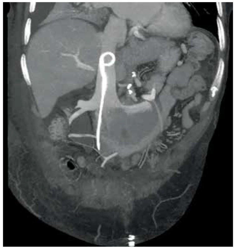 Uložení stentu v dolní duté žíle<br>
Fig. 1. Double J stent in the inferior vena cava