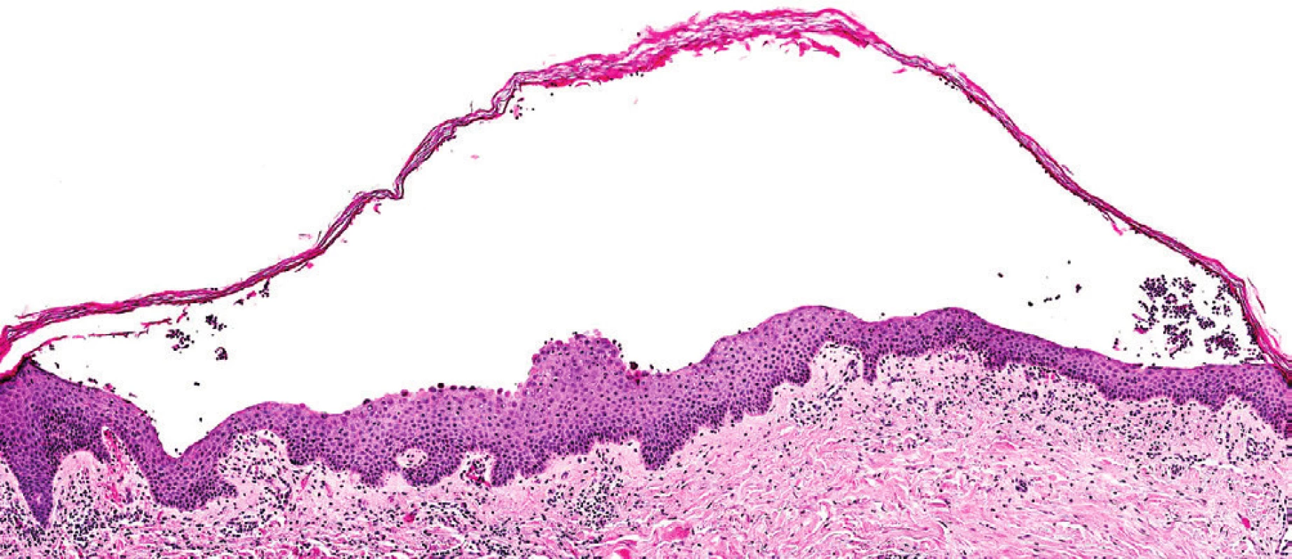 Histologický obraz IgA pemfigu. Při použití
imunohistochemického barvení byla v kožní morfě prokázána
depozita imunoglobulinu typu IgA.
