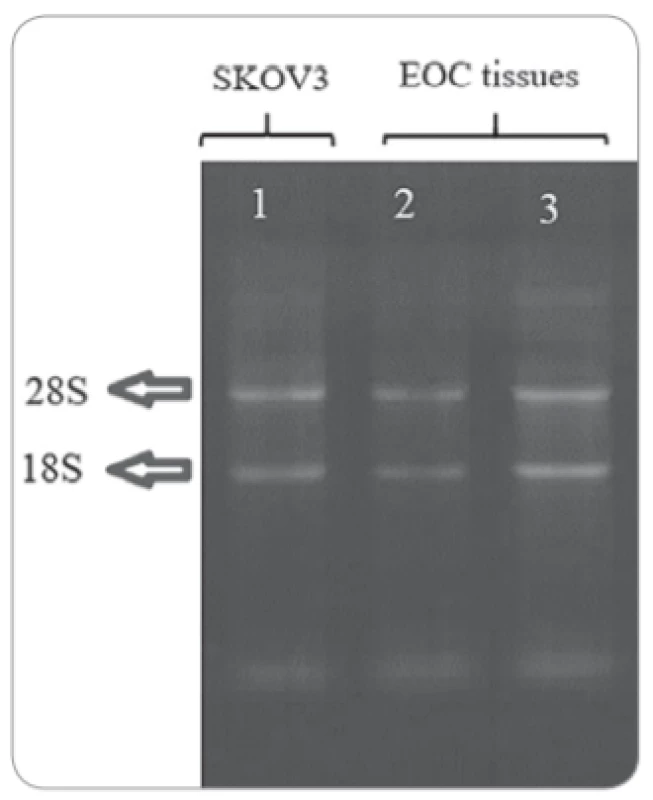Denaturing gel electrophoresis
stained with ethidium bromide showing
total RNA extracted from cell line (SKOV3) and ovarian tissue samples of patients
with EOC. 