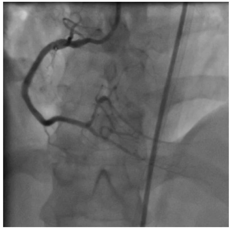 Finální výsledek po implantaci a následné vysokotlaké postdilataci
tří lékových stentů