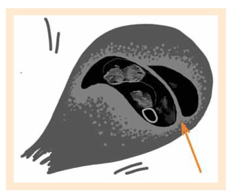 a. Lambda sign, schematické znázornění ultrazvukového
nálezu (autor: Osičková V).<br>
Fig. 1a. Lambda sign, schematic representation of an ultrasound
finding (author: Osičková V).