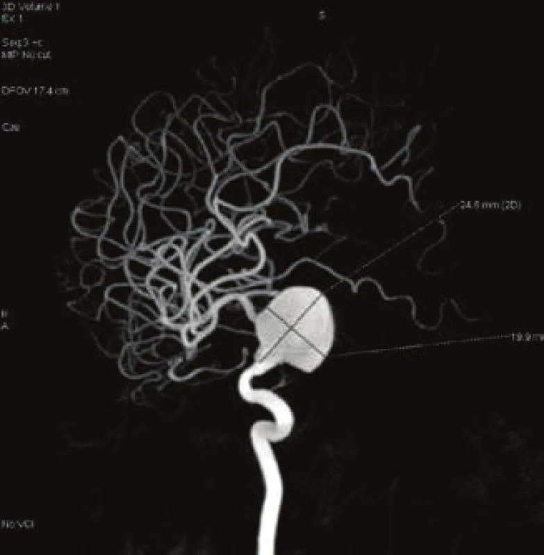 Gigantic fusiform aneurysm of arteria ophthalmica in
right eye