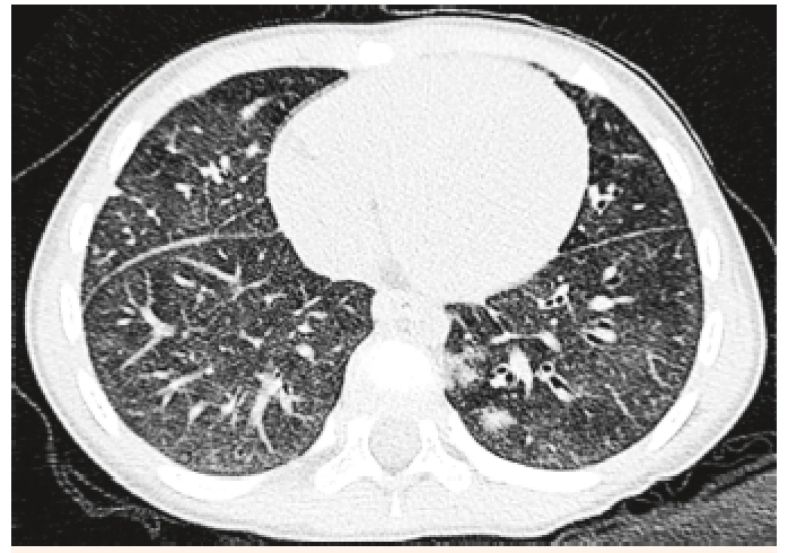 HRCT pľúc – vľavo parakadiálne hemoragické ložisko
u 4-ročnej pacientky.<br>
Fig. 4. HRCT examination of lung – left paracardial haemorrhagic
bearing in a 4-year patient.