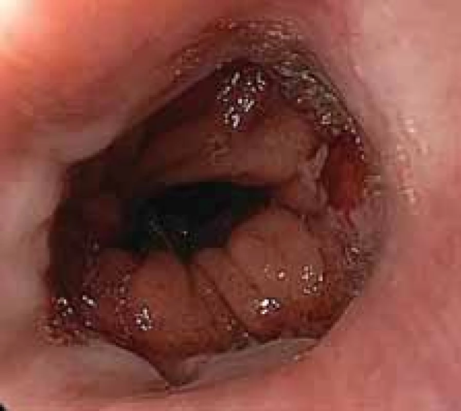 Minor leak in esophagojejunal anastomosis following total gastrectomy. Prolonged healing required
endoscopic vacuum assisted closure therapy.<br>
Obr. 8. Malý leak ezofagojejunální anastomózy po totální gastrektomii. Prodloužené hojení vyžadovalo využití endoskopické vakuové terapie.