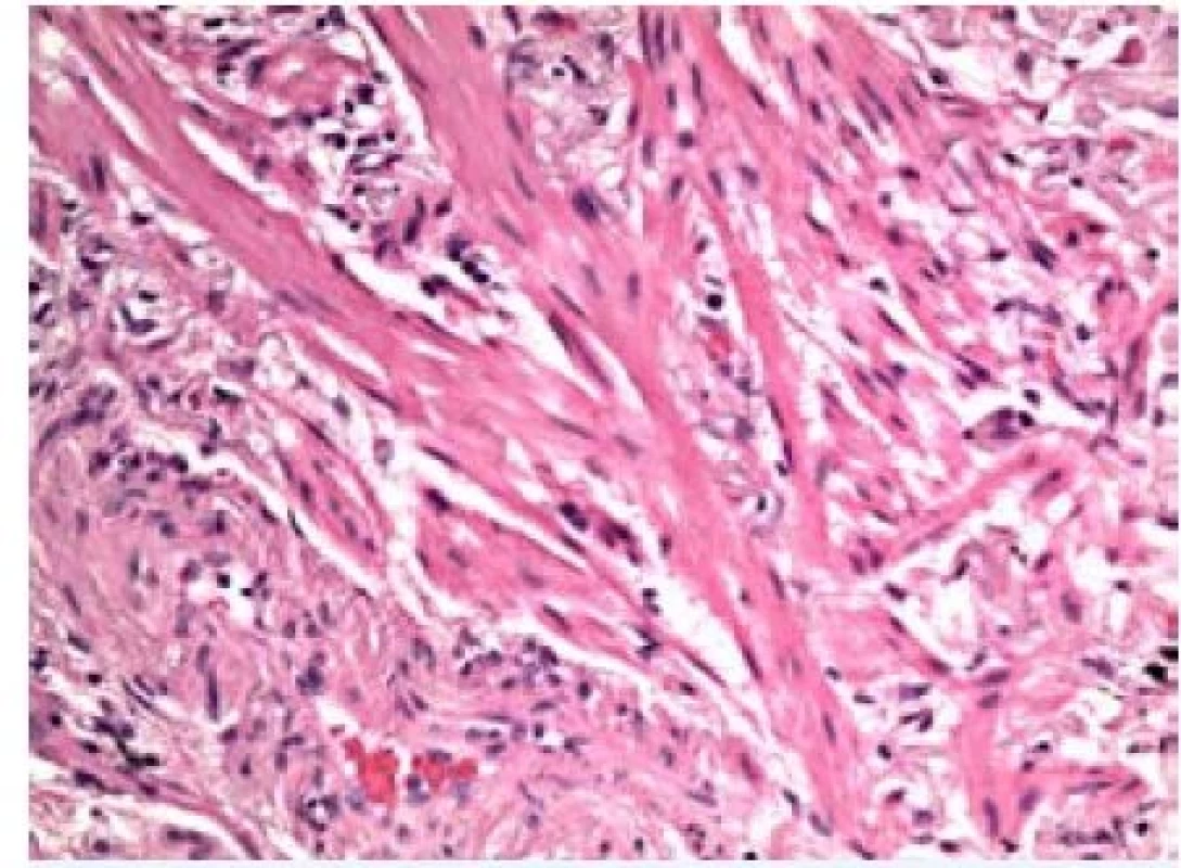 Fibroblastový fokus (barvení hematoxylin-eozin,
zvětšení 20×)