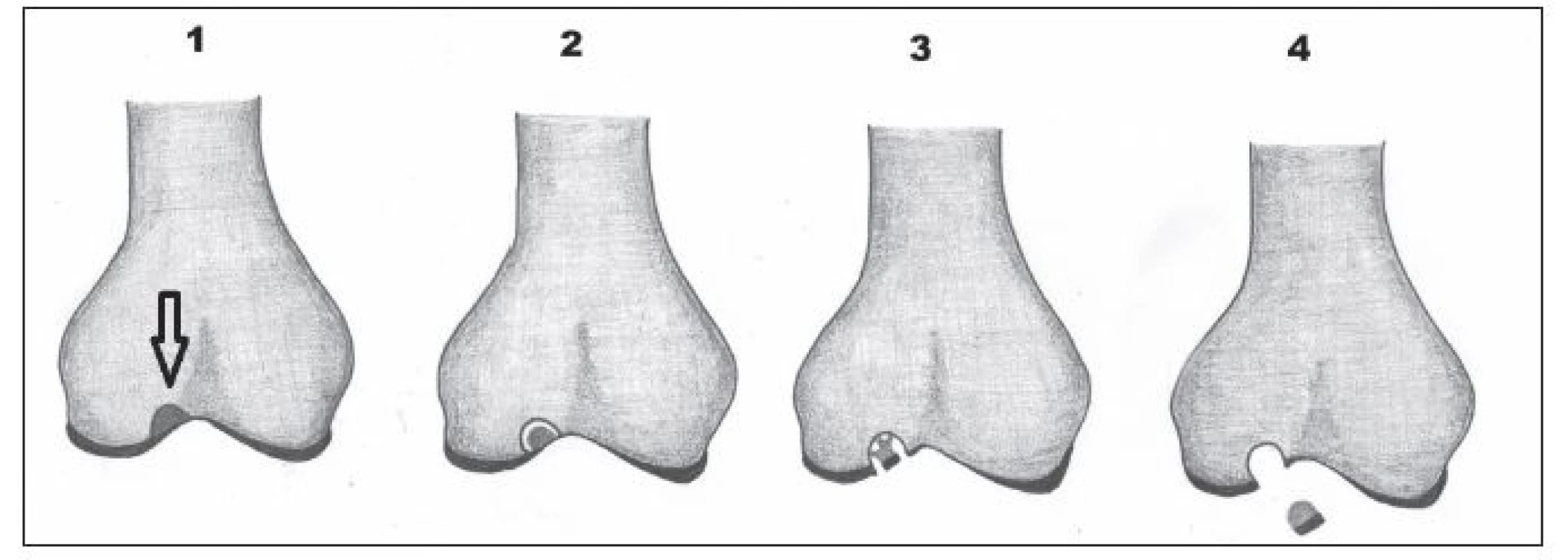 Stádia disekující osteochondritidy 1–4. 1 – vyznačená stabilní léze v kosti, 2 – naznačené odloučení fragmentu v kosti,
3 – fragmentace chrupavky, 4 – dislokace fragmentu.