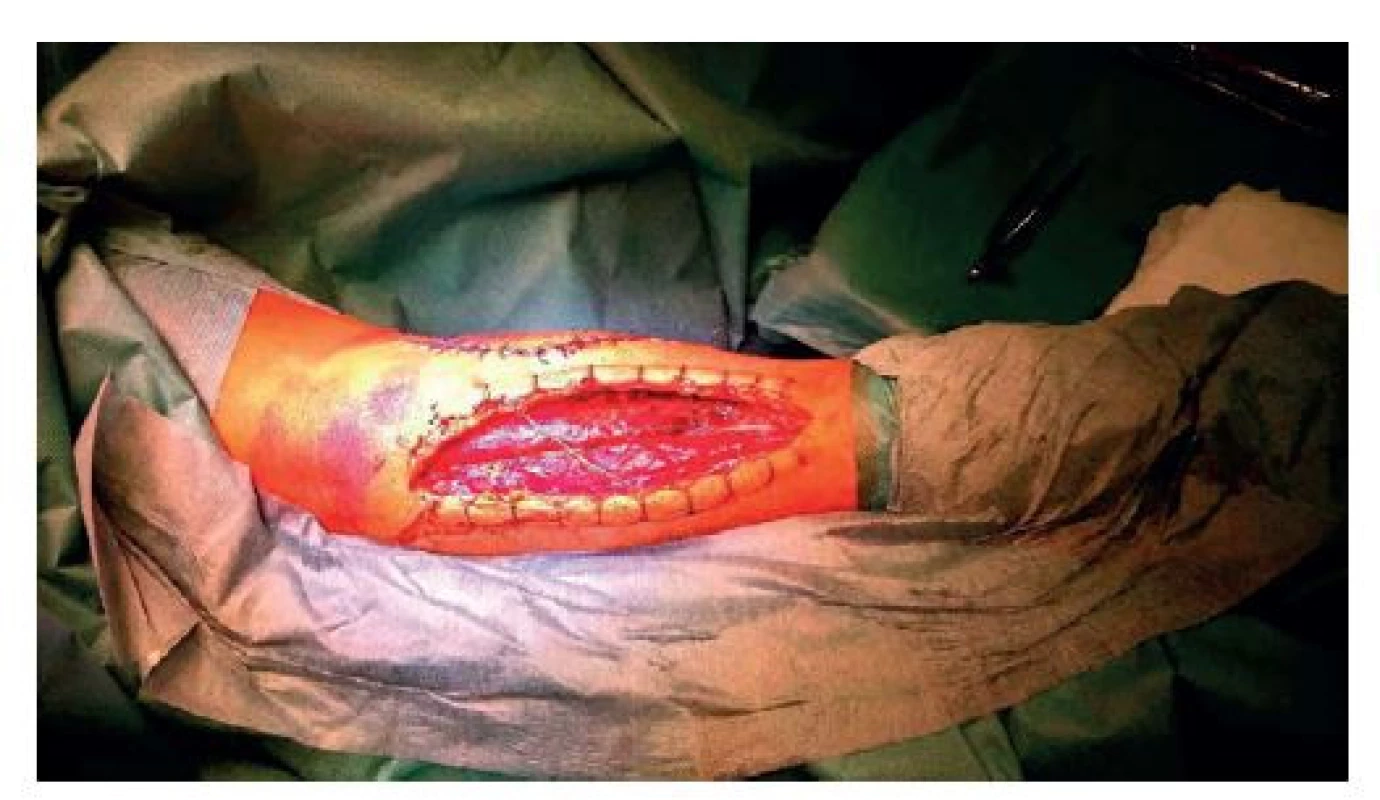 Zakládání elastické ligatury dorzální rány LHK<br>
Fig. 3: Elastic ligature of the dorsal wound on the left
upper limb