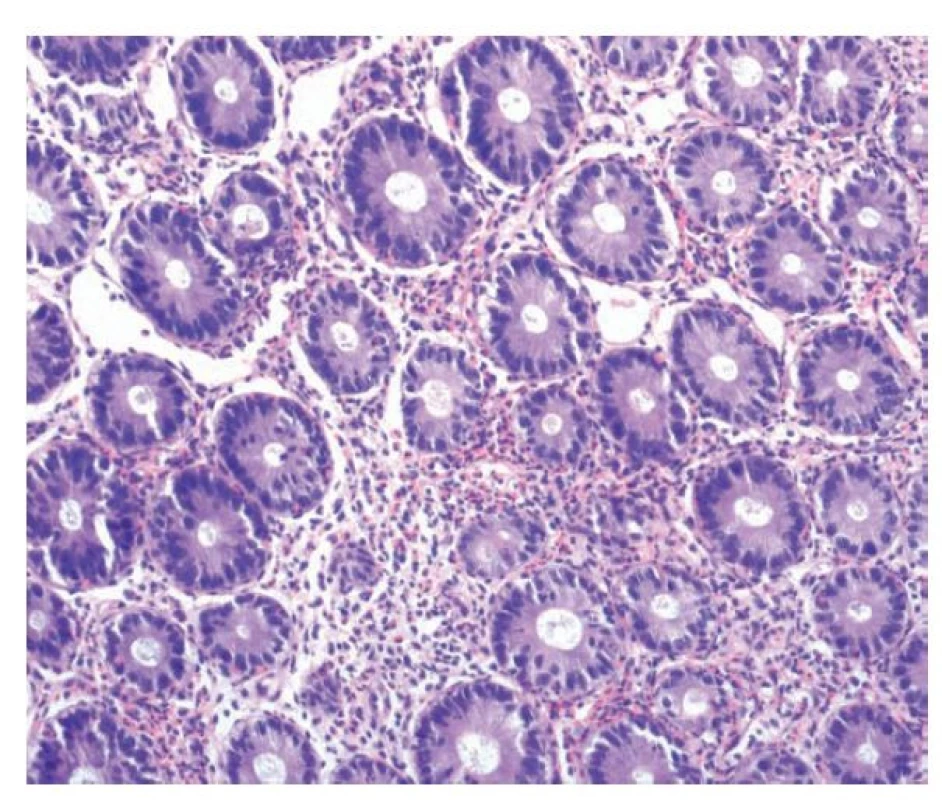 Eosinofilní kolitida. V lamina propria kolické sliznice je zánětlivá celulizace
s převažující účastí velmi početných eosinofilů, které jeví tendenci ke
shlukování a místy prostupují do výstelky krypt (hematoxylin a eosin; 200x).