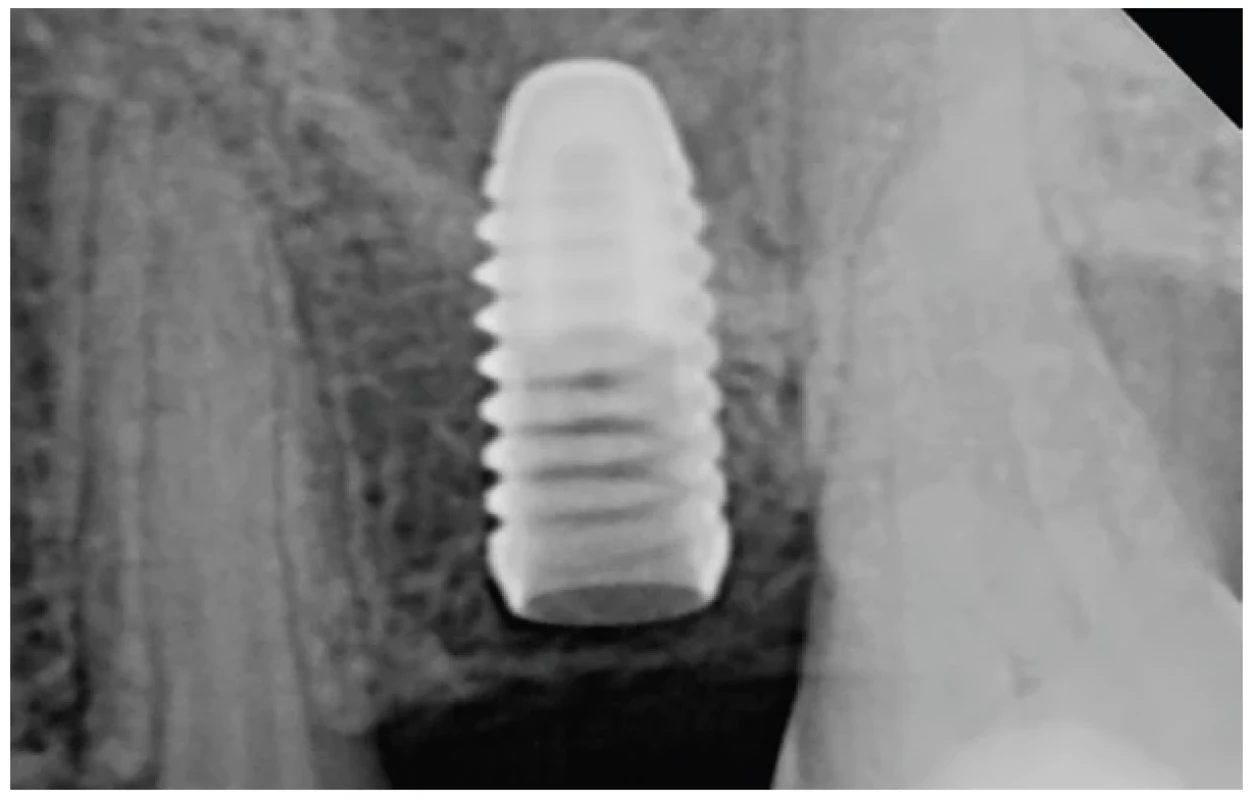 RTG verifikace pozice
implantátu ihned po
implantaci bez přidání
alograftu. Schneiderova
membrána je nadzdvižena
oblým hrotem implantátu <br> 
Fig. 5 Radiographic verification of
the implant position without
adding of the allograft
material. The Schneiderian
membrane is lifted by the blunt
apex of the implant