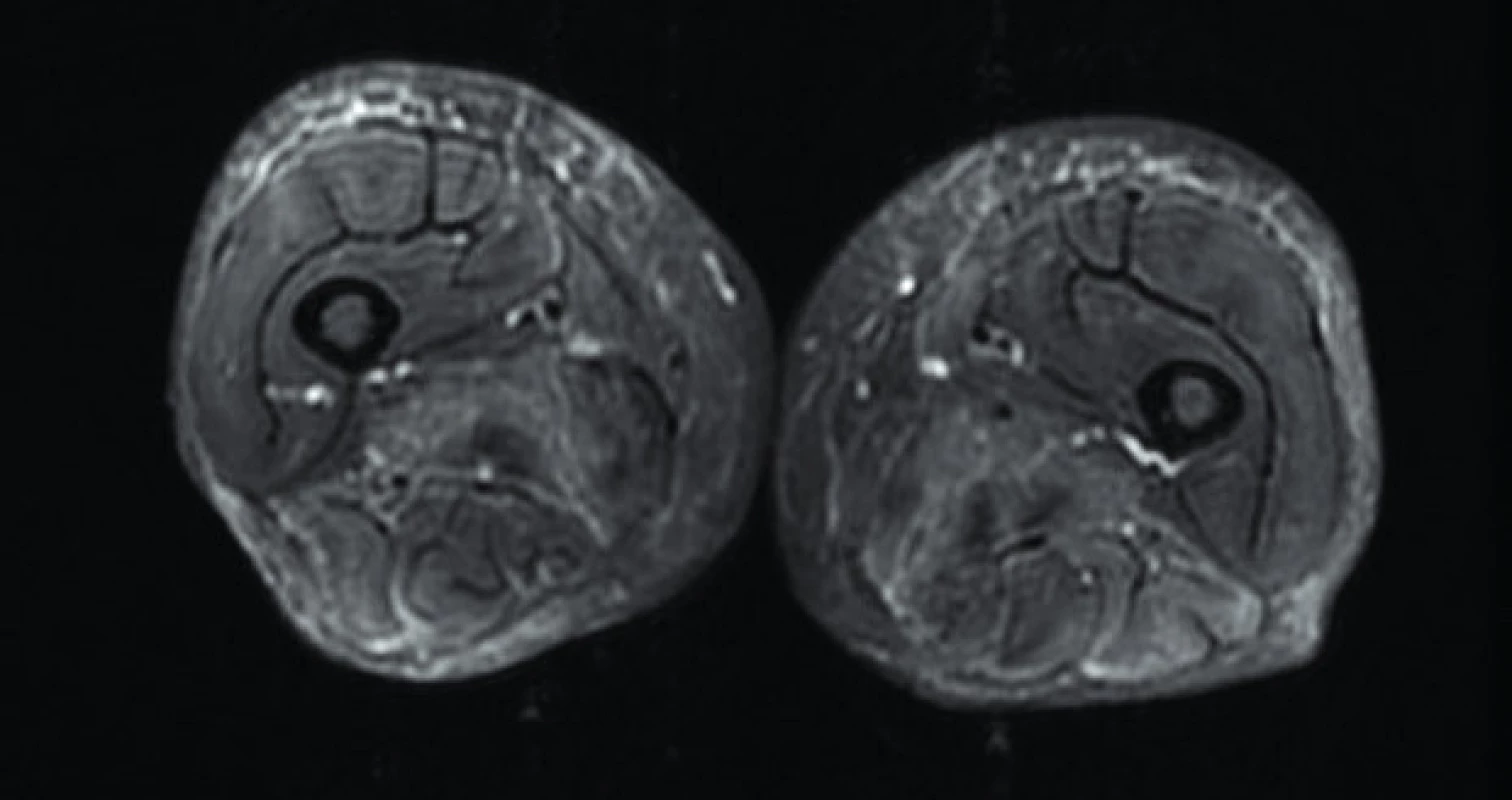 Axiální STIR sekvence – postižení kůže a podkoží u pacienta s dermatomyozitidou. Zdroj: Archiv Revmatologického ústavu (ÚVN Střešovice, Discovery 450; 1,5 T)