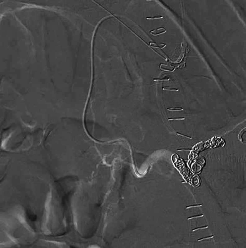 Stav po transarteriální embolizaci aneuryzmatu 
PDA se zavedenými coily – snímky digitální subtrakční 
angiografie<br>
Fig. 3: Condition after transarterial embolisation of the 
PDA aneurysma with deployed coils – images of digital 
subtraction angiography