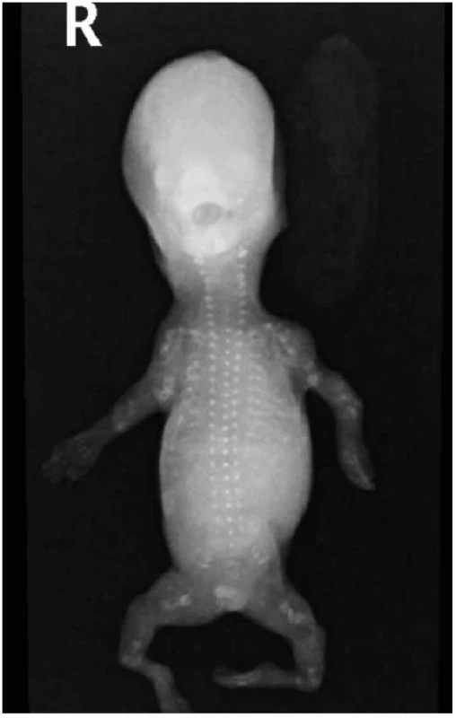Osteogenesis imperfecta (vs. 2C dle Sillence), plod 13. týden, RTG.
Generalizovaná demineralizace skeletu, defektní osifikace neurokrania.
Vícečetné fraktury kostí, mikromelie.