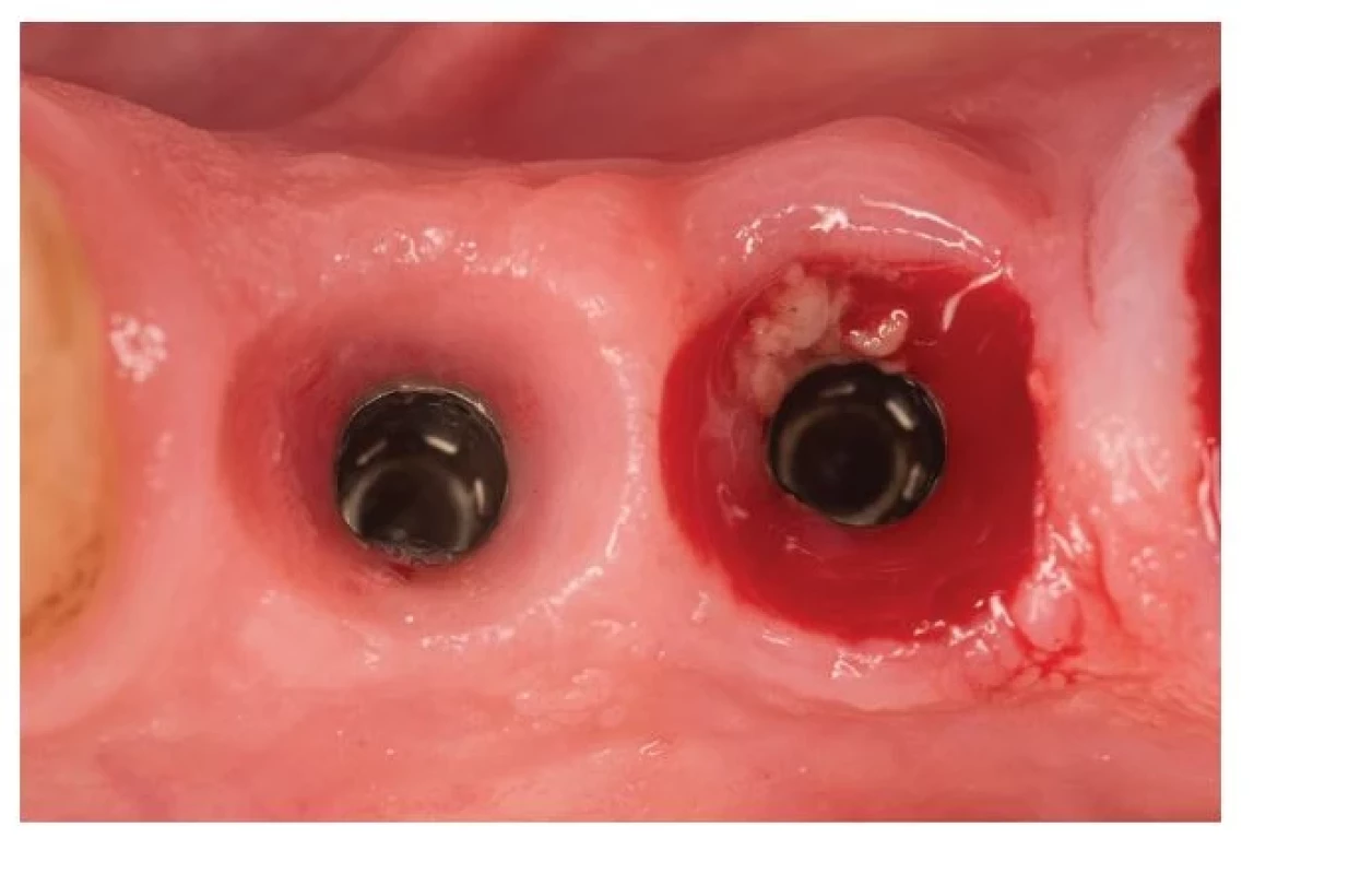 Mukozitída.<br>
Fig. 3
Mucositis.