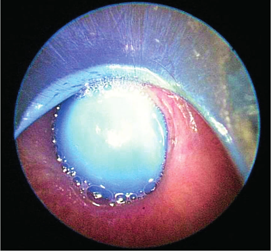 Kulovité cizí těleso v jícnu. <br><b>Fig. 6.</b> Spherical foreign body in the esophagus.