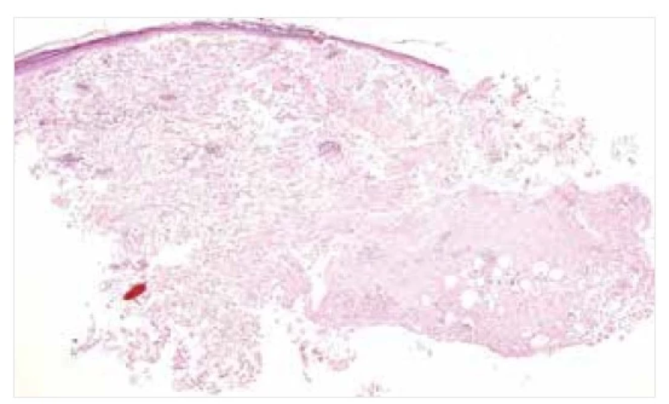 Nodulární amyloidóza – histopatologie<br>
Amorfní eozinofilní depozita amyloidu v dermis a podkoží.
Barvení HE, původní zvětšení 20krát.