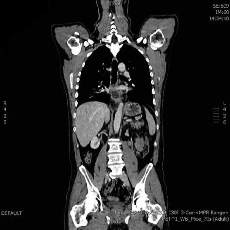 Kontrolní PET/CT v rámci restagingu po neoadjuvantní
radiochemoterapii (koronární řez)<br>
Fig. 2: PET-CT in restaging after neoadjuvant chemoradiotherapy
(coronal reconstruction)