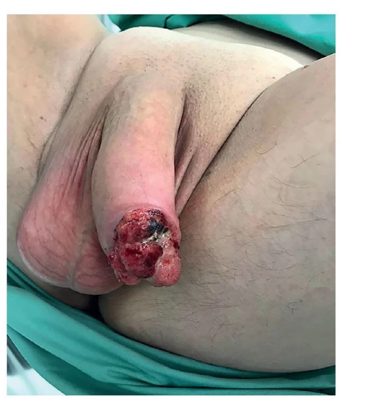 Angiosarkom penisu<br>
Fig. 1: Penile angiosarcoma