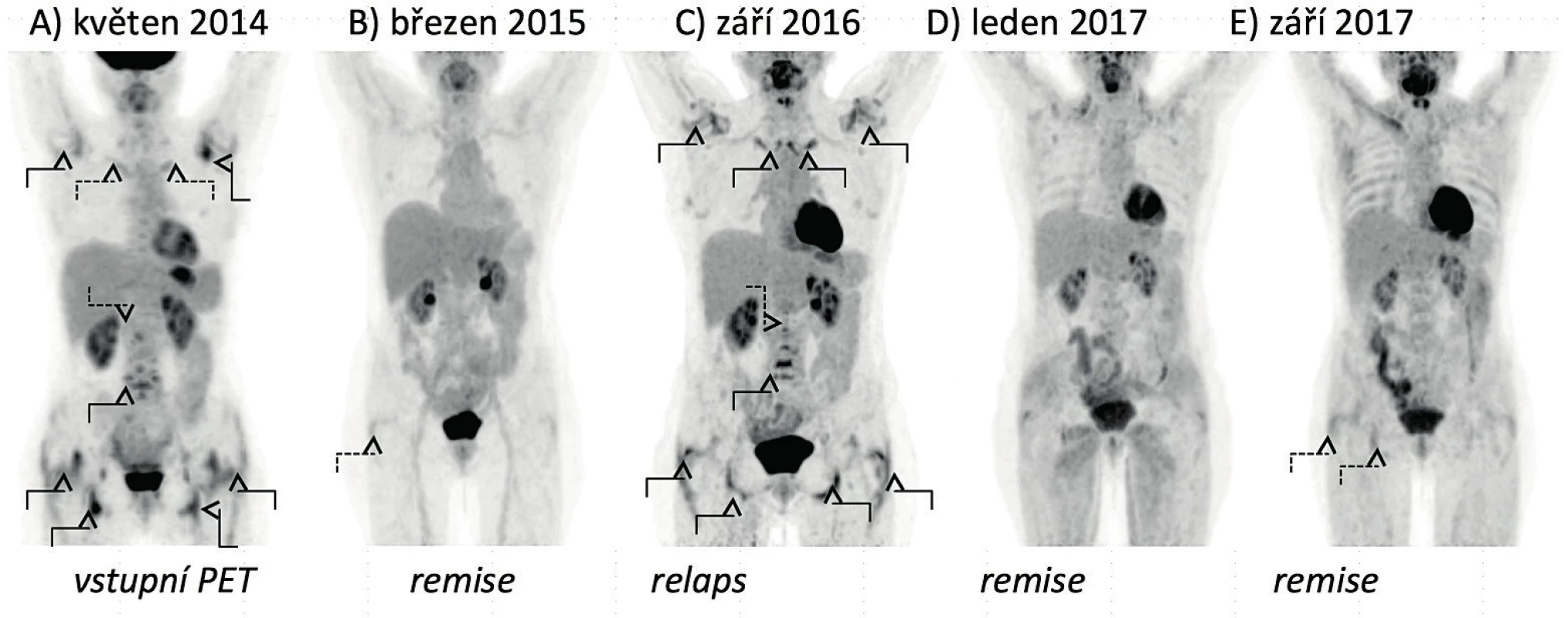 Vývoj nálezů FDG-PET/CT vyšetření u pacientky s polymyalgia rheumatica. A) Vyšetření prokazuje zvýšenou akumulaci FDG
v glenohumerálních, sternoklavikulárních a kyčelních kloubech, v prostorách mezi spinózními výběžky obratlů krční a bederní páteře,
v oblastech pertrochanterických a ischiogluteálních burz a kolem zevních hran stydkých kostí. B) Vyšetření prokazuje remisi onemocnění
s pouze mírnou akumulací FDG v oblasti pravé pertrochanterické burzy. C) Vyšetření prokazuje relaps onemocnění s aktivní synovitidou
glenohumerálních, sternoklavikulárních a kyčelních kloubů a nálezem synovitidy v interspinózních prostorách krční a bederní páteře,
v pertrochanterických a ischiogluteálních burzách a s naznačenou aktivitou prepubicky. D) Vyšetření prokazuje remisi onemocnění.
E) Vyšetření prokazuje remisi onemocnění s pouze mírnou akumulací FDG v oblasti pravé pertrochanterické a ischiogluteální burzy.