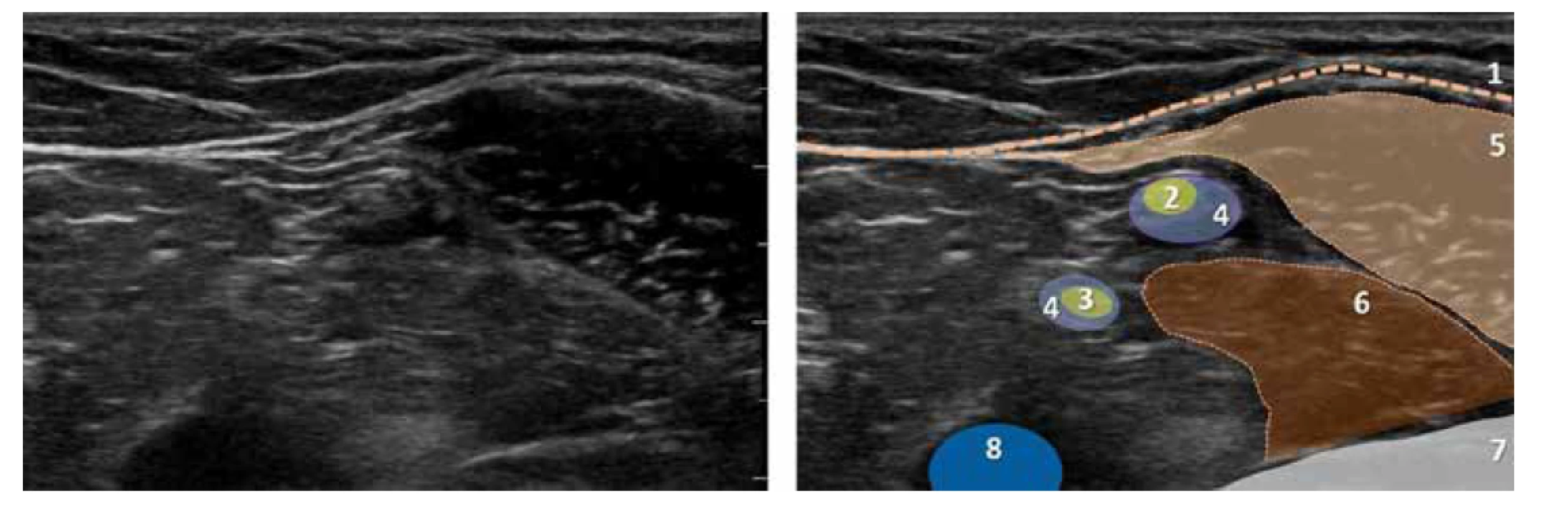 UZ obraz popliteální krajiny po aplikaci lokálního anestetika k bifurkaci n. ischiadicus. 1. hluboká fascie, 2. n. peroneus communis, 3. n. tibialis,
4. lokální anestetikum, 5. m. biceps femoris, 6. zevní hlava m. gastrocnemius, 7. tibie, 8. v. poplitea