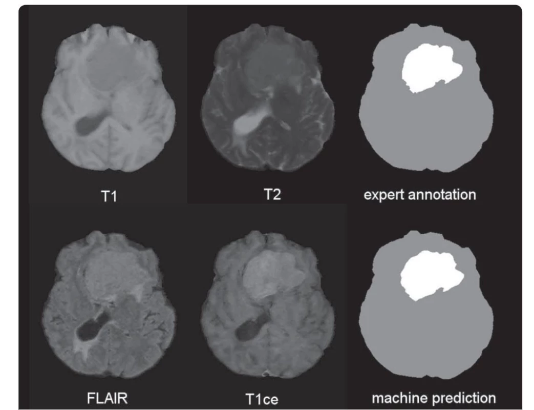 Ukázka vstupních dat nádoru mozku pořízených ve čtyřech modalitách MR: T1, T2, FLAIR a T1ce (T1 s kontrastní látkou).
V pravém sloupci je srovnání ruční anotace správného výsledku segmentace postižené části mozku a výsledku automatizované počítačové
analýzy.