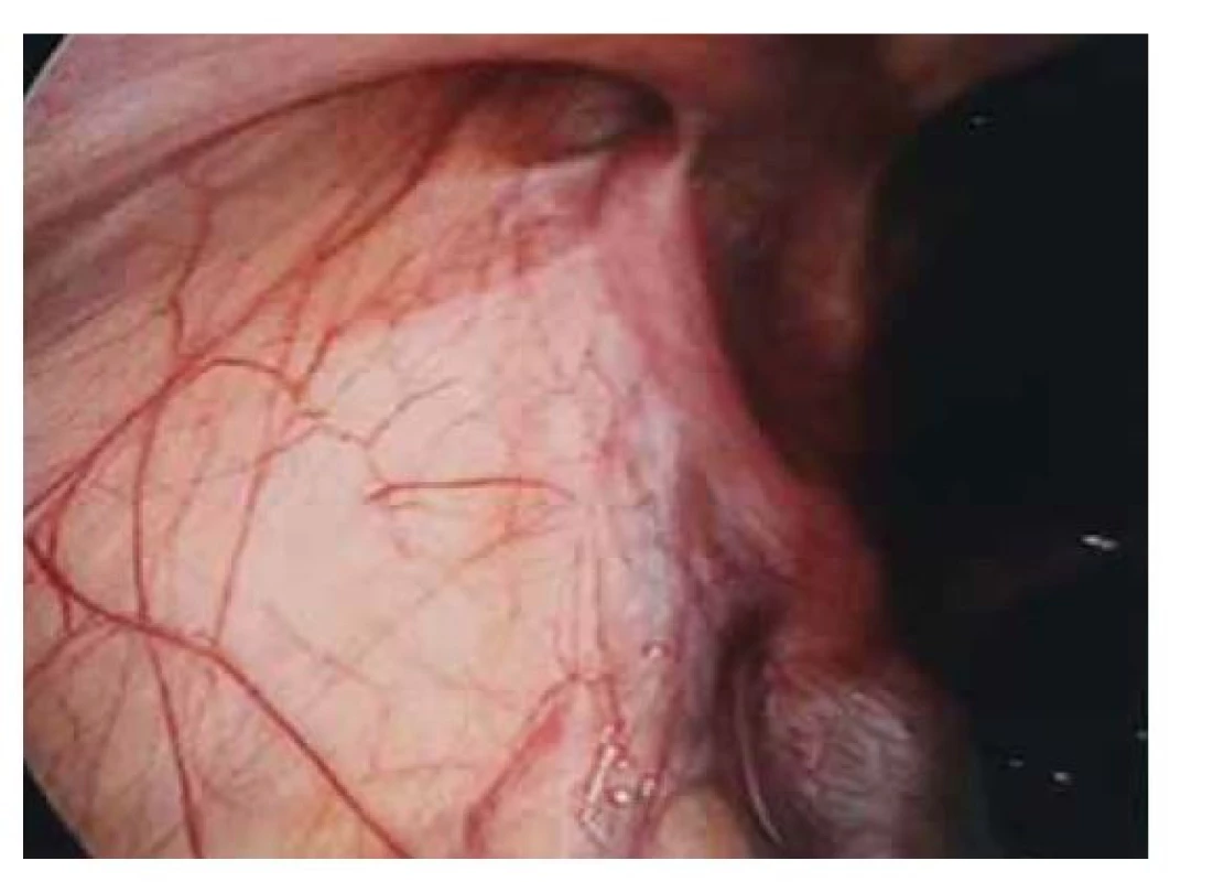 Nepřímá inguinální hernie vlevo.<br>
Fig. 2. Indirect inguinal hernia on the left side.