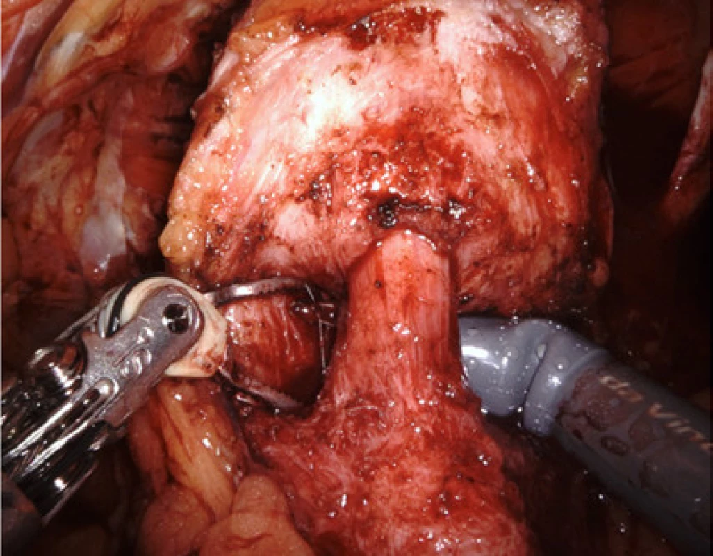 Ukazuje další fázi při šetření hrdla, kdy je již hrdlo
kompletně uvolněno od prostaty a obejito nástroji<br>
Fig. 2. The subsequent phase of bladder neck preservation with the neck being completely separated from the
prostate and with instruments placed around i