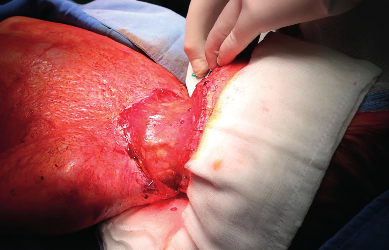 Transfer of the dermo-epidermal graft onto the Matriderm® matrix in a single-step procedure