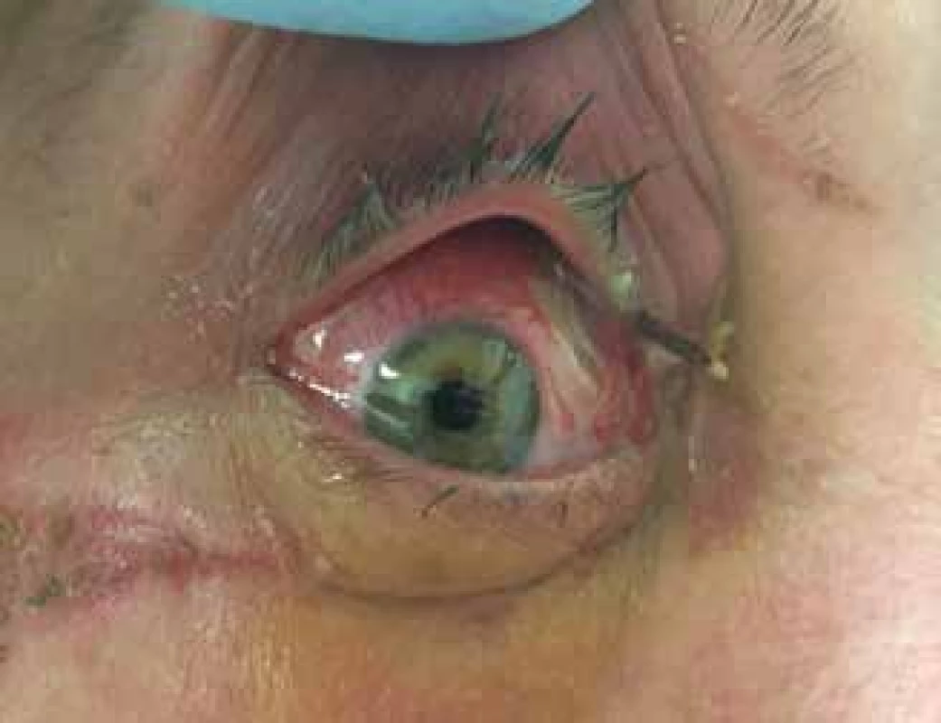 a. Patient with foreign body in orbit. The cause was a fall in
the forest, the eyeball was not damaged
