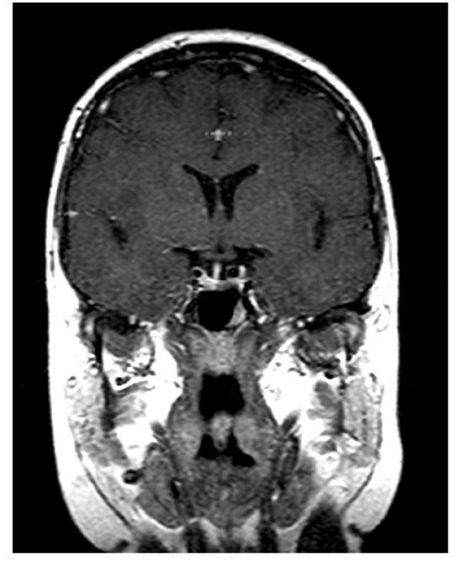 MR obraz mikroadenomu hypofýzy (archiv autora
a Radiodiagnostické kliniky Všeobecné fakultní nemocnice a 1. LF UK v Praze)