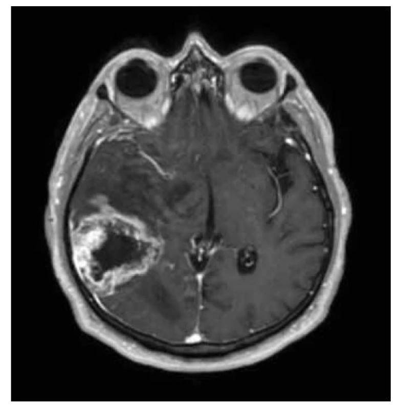GBM IDH-wild type gr. 4, T1W+kontrast.