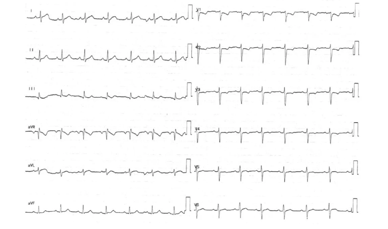 Vstupní EKG (archiv autorů)