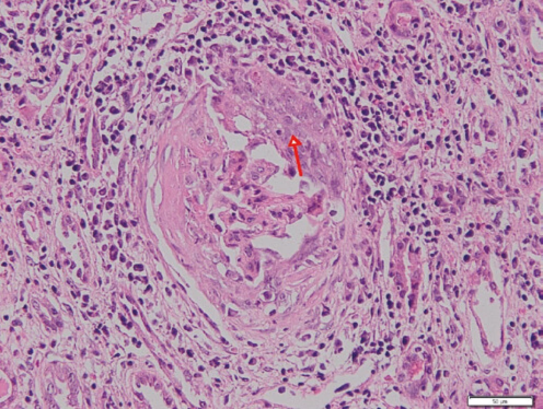 Glomerulus s celulárním srpkem (červená šipka), v okolí glomerulu 
je v intersticiu intenzivní zánětlivý infiltrát; barvení HE