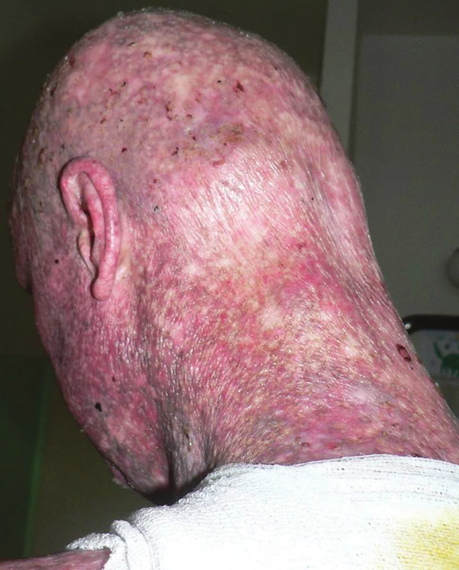 Alopecie