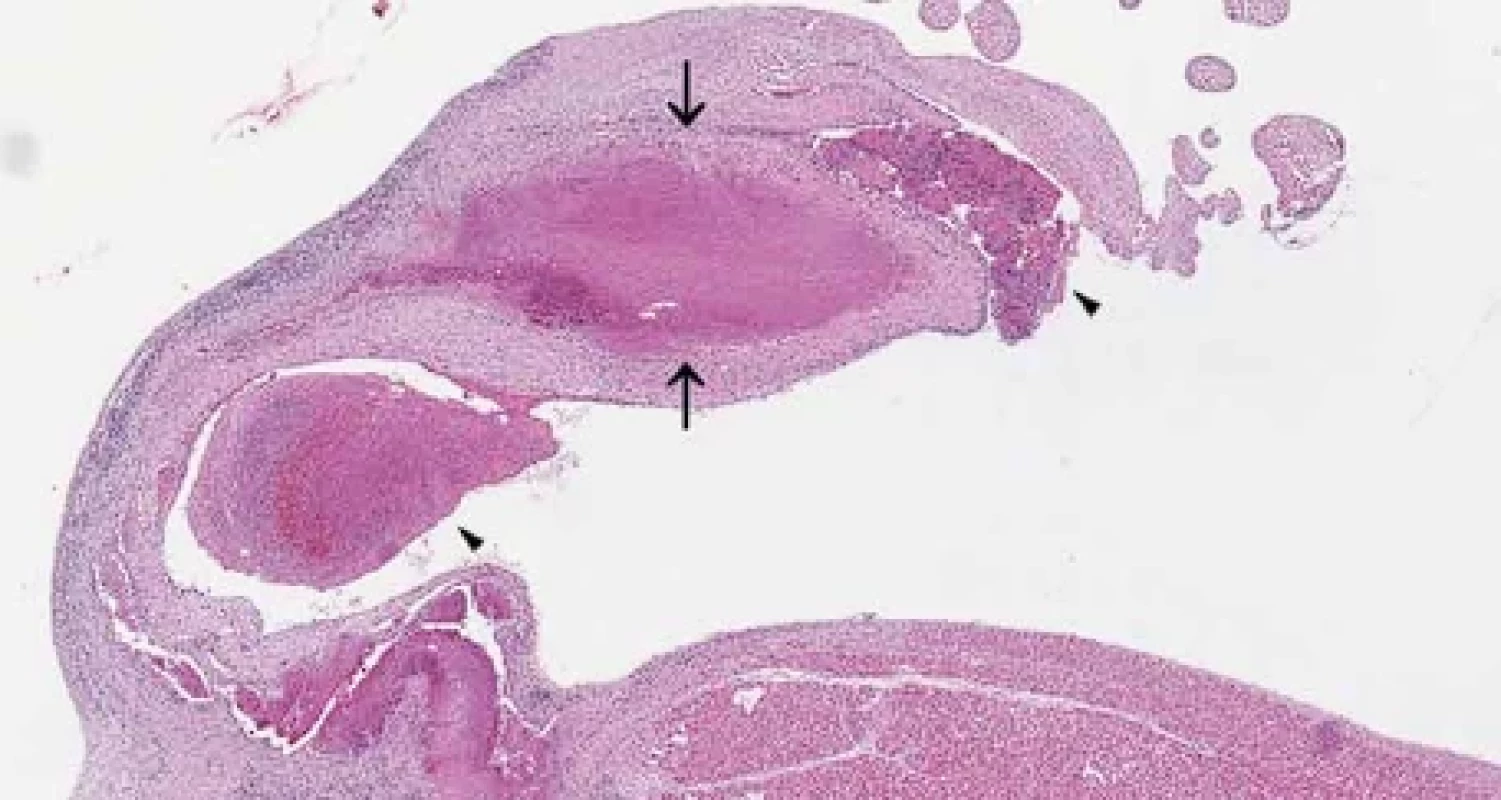 Low power view of the mitral valve with rheumatoid nodule (between arrows) and infective vegetations (arrowheads). HE, 17x magnification.