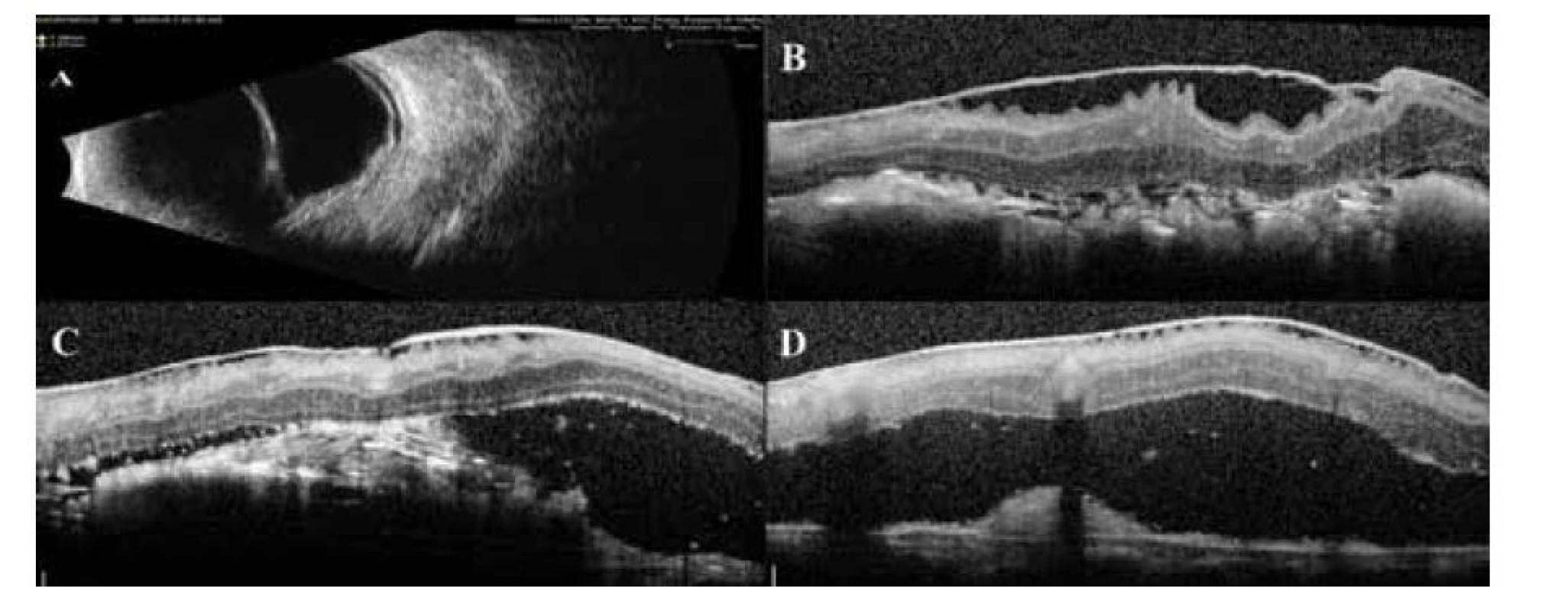 USG vyšetrenie ĽO (B sken). Tumor sietnice veľkosti 7,26 x 2,07 mm s exudatívnym nadvihnutím
sietnice (A), OCT vyšetrenie ĽO, prítomná ERM s nadvihnutou neurosenzorickou sietnicou (B–D)