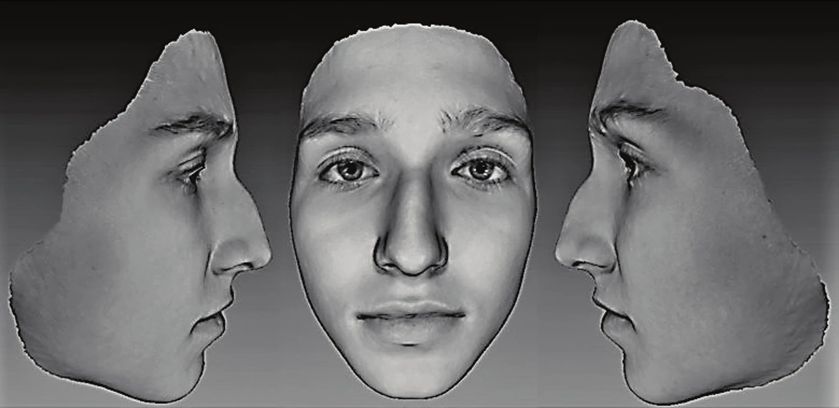 3D fotografie převedené do 2D zobrazení, zhotovené přístrojem Vectra M3 (pacientka i její zákonný zástupce podepsali informovaný souhlas se zveřejněním fotografií)<br>
Fig. 2 3D figures converted into a 2D view, made by the Vectra M3 (the patient and her legal guardian have signed informed consent and agreed with the publication of photos)