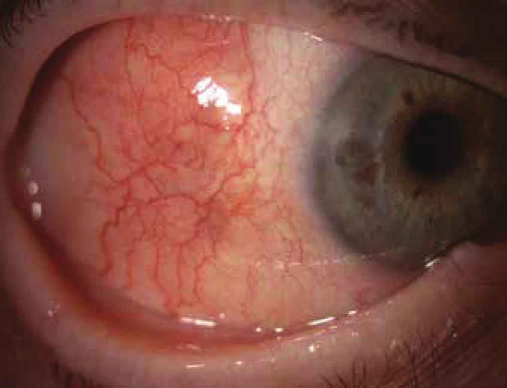 Nodular scleritis