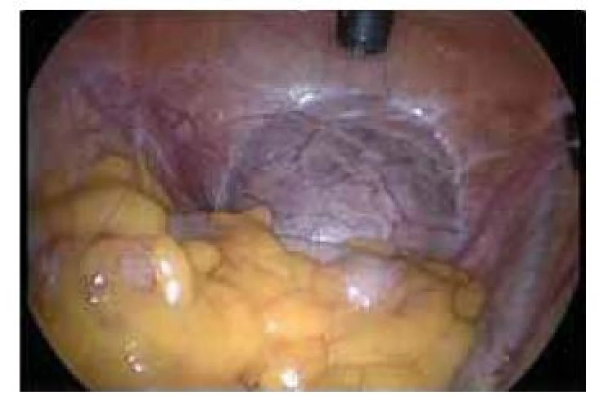 Laparoskopický pohled na
graviditu v jizvě po císařském řezu.
Gestační stáří – 11. týden.<br>
Fig. 3. Laparoscopic view of pregnancy
through a scar after caesarean section.
Gestational age – 11th week.