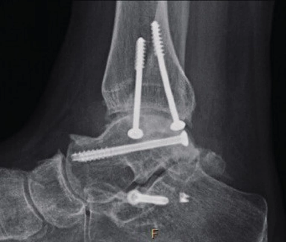 Ankle arthritis according to X-ray examination (AP and lateral
projection of the ankle