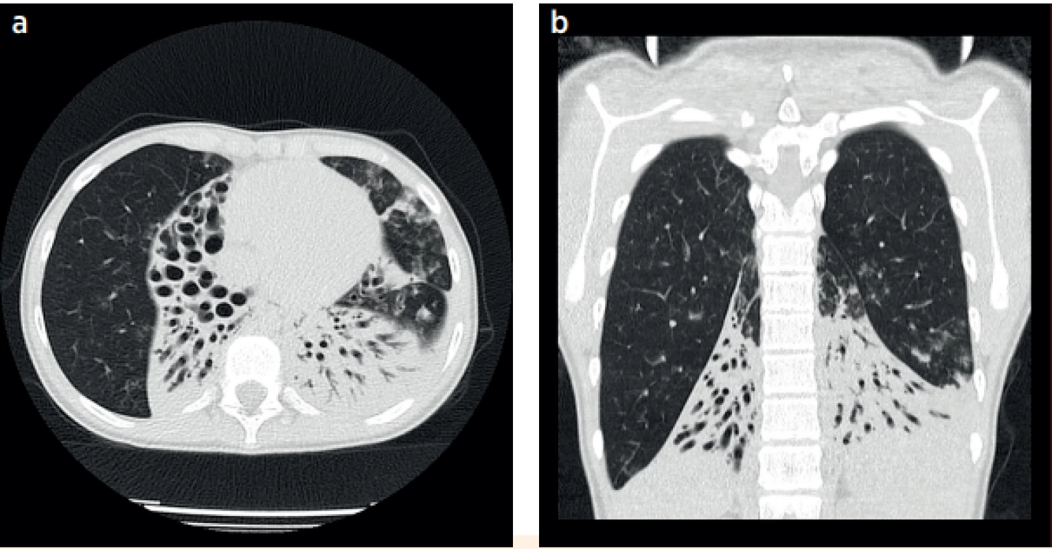 a, b. CT plic, 13letá pacientka s rozsáhlým plicním postižením a respirační insuficiencí, atelektázy s bronchiektáziemi postihující téměř kompletně oba dolní laloky, pravý střední lalok a lingulu.<br>
Fig. 6a, b. CT of the lungs, 13-year-old patient with a severe pulmonary impairment and respiratory insufficiency, atelectasis together with bronchiectasis localised in basal lobes bilaterally, right medial lobe and the lingula.