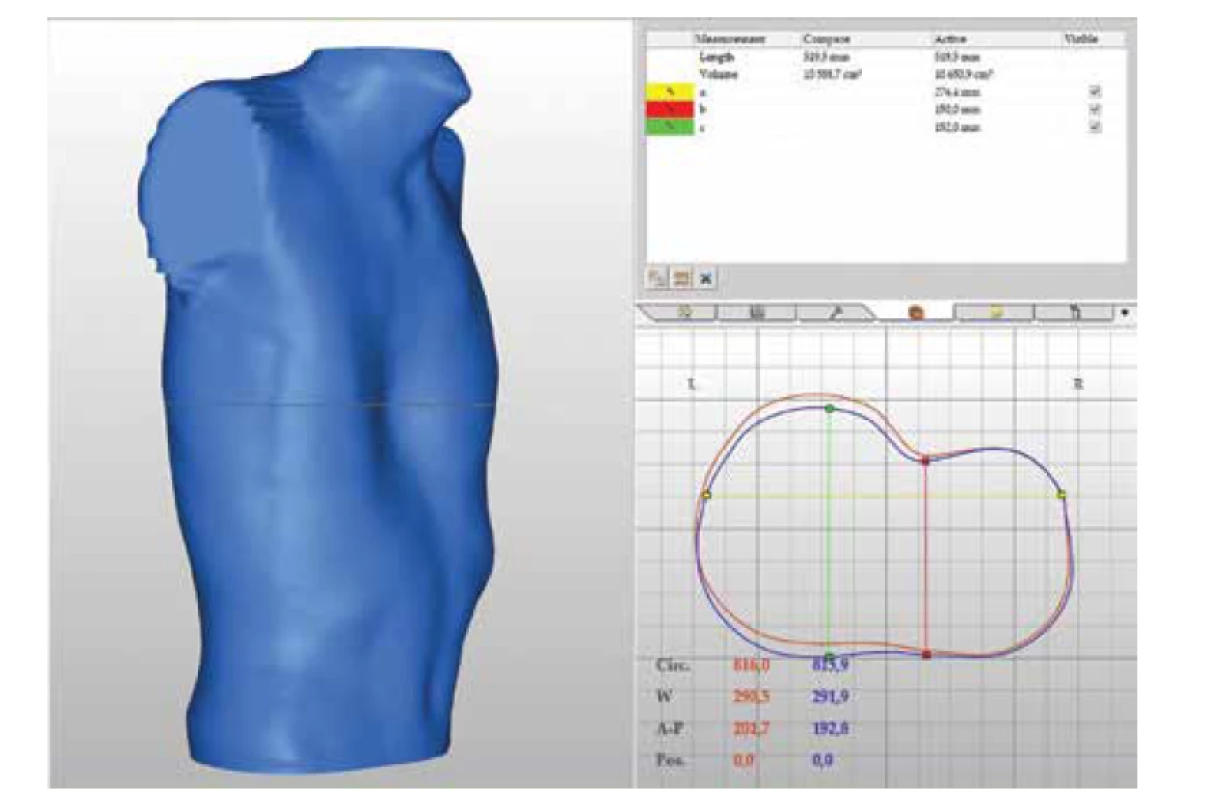Ukážka výsledku 3D skenovania hrudníka (archív KDCH UNM).<br>
Fig. 3. Example of the result of a 3D chest scan.