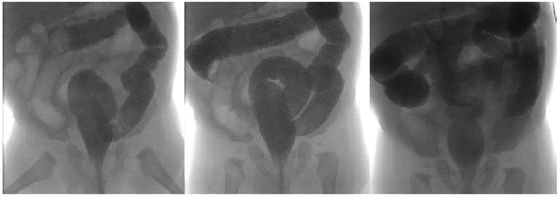 Hydrostatická desinvaginace IC invaginace v oblasti c. transversum <br>
Postup kontrastní látky při hydrostatické desinvaginaci IC v oblasti c. transversum (zleva do prava); vpravo úspěšná desinva-ginace s refluxem kontrastní látky do terminálního ilea <br>
Fig. 2: Hydrostatic reduction of an intussusception at the level of transverse colon <br>
Contrast flow in the course of hydrostatic reduction of the intussusception in the transverse colon region (from left to right); on the right: Successful reduction showing the flow of the contrast into the terminal ileum.