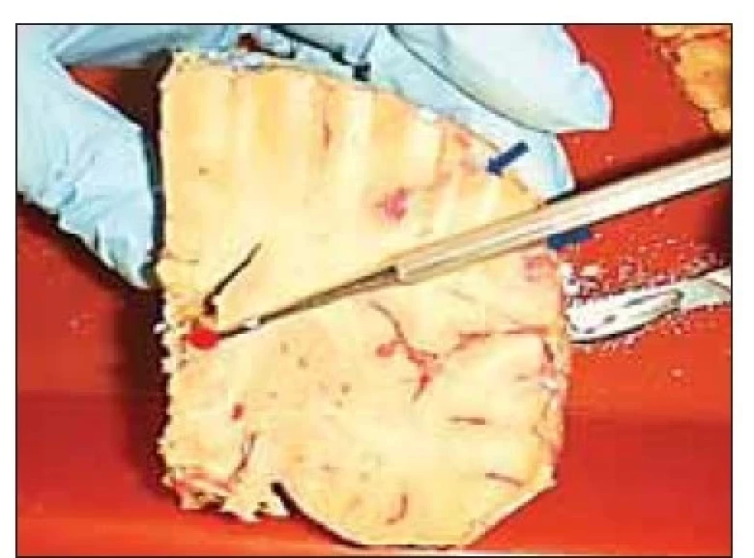 Laterální trajektorie elektrody do
nucleus anterior thalami – naznačeno
pátradlem. Modré šipky vymezují laterální
koridor pro zavedení elektrody do
nucleus anterior thalami (vyznačeno červeným
polem).<br>
Fig. 3. Lateral trajectory of the anterior
thalamic nucleus electrode – marked by
the probe. Blue arrows delineate the lateral
corridor for the anterior thalamic
nucleus (red dot) electrode.